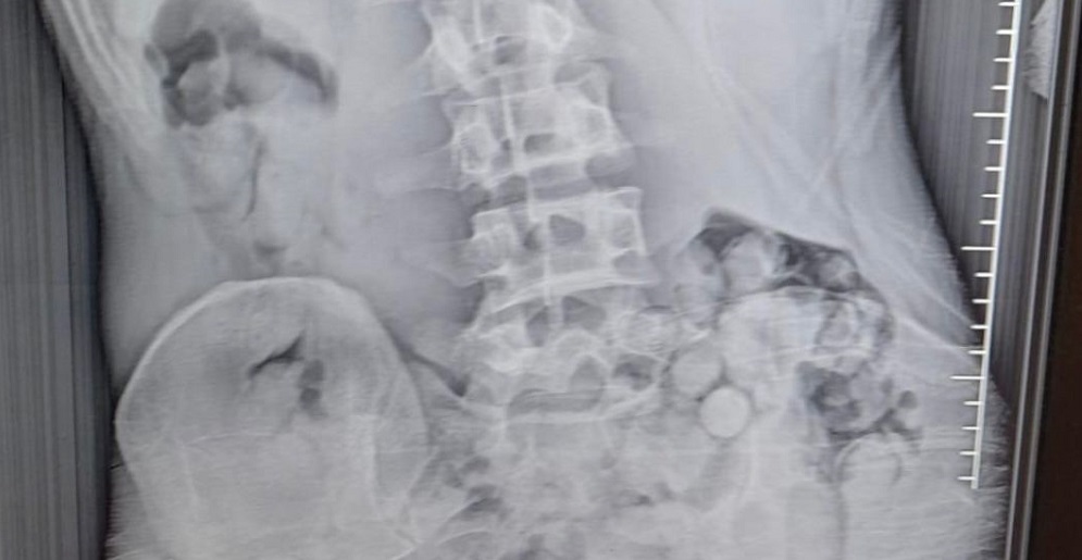 Midesinde 309 gram uyuşturucuyla yakalandı