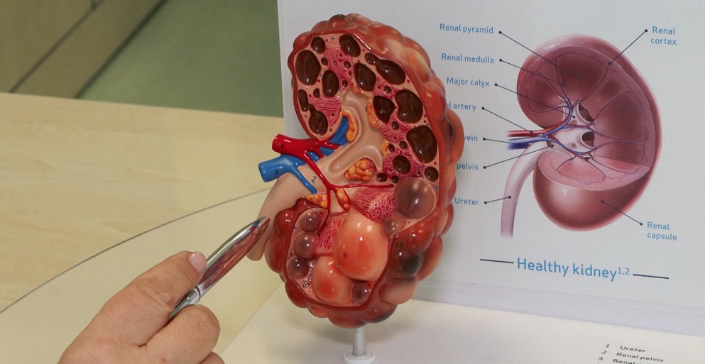 Böbrek hastalıkları sessizce ilerliyor