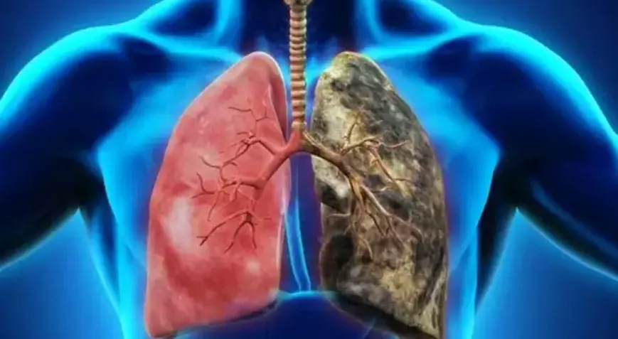 "3 milyon kişi KOAH olduğunun farkında değil"