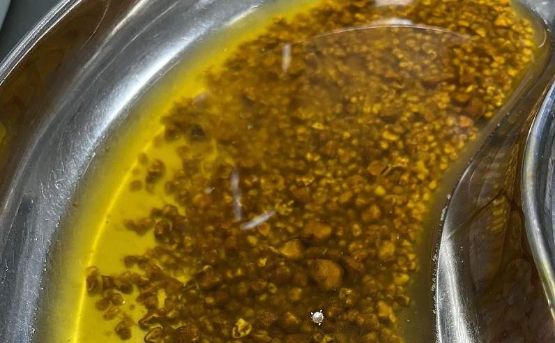 Safra kesesinden 2 bin 67 taş çıkarıldı