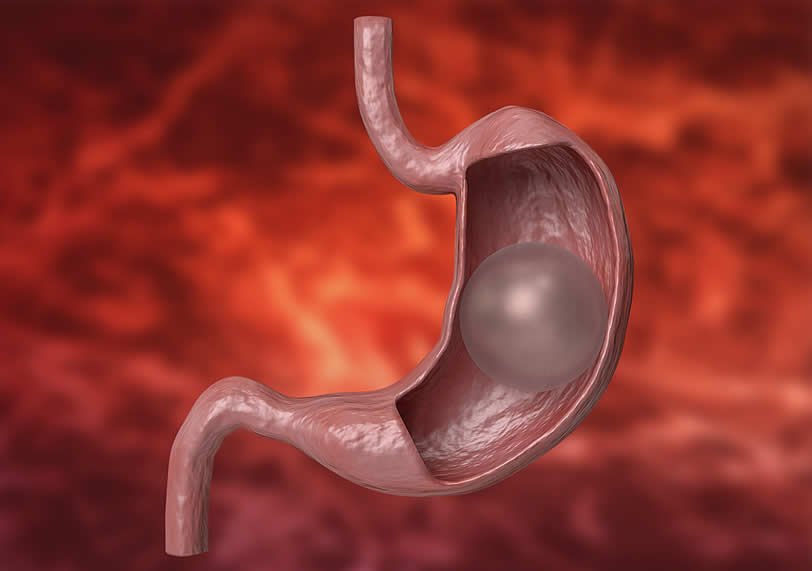 Mide balonu ile ilgili merak edilen 5 soru